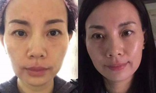 美容除皱方法（美容除皱纹的方法）