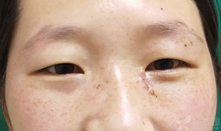 眼角有痣代表什么（女人眼角有痣代表什么）