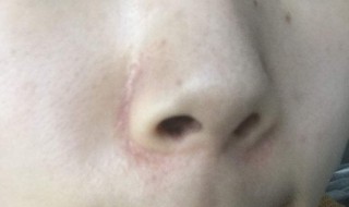 脸上有黑头怎么办 脸上有黑头是什么原因