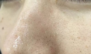 怎样去鼻子黑头（鼻子黑头怎么解决）