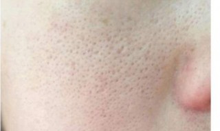 怎样收缩毛孔最有效又简单 毛孔粗大黑头多皮肤油应该怎么办