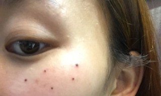 脸上的痣哪些不能点掉 脸上哪些痣不能点图片