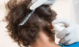 头上长虱子怎么办怎样消除 头上长虱子怎么根治