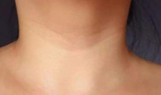 颈纹怎么消除简单方法 颈纹怎么消除简单方法视频