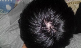 脱发了如何能让头发再生 脱发如何再生长