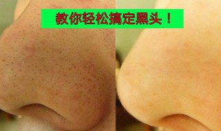 清理黑头最有效的方法（清理黑头最有效的方法是什么）