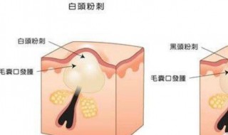 脸上粉刺闭口怎样消除（脸上粉刺闭口怎样消除最快）