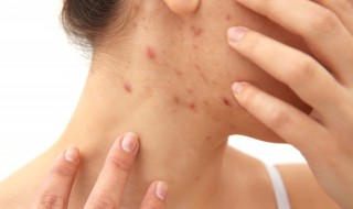 背后痘痘怎么去除 背后痘痘怎么去除小红书